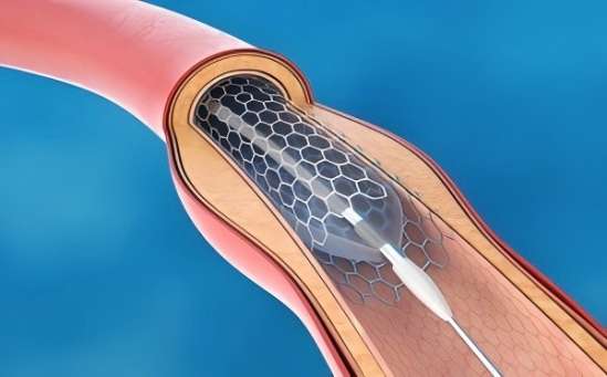 What Is a Balloon Catheter Used For?