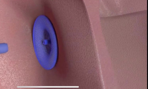 World's First Fully Absorbable Occluder Launched