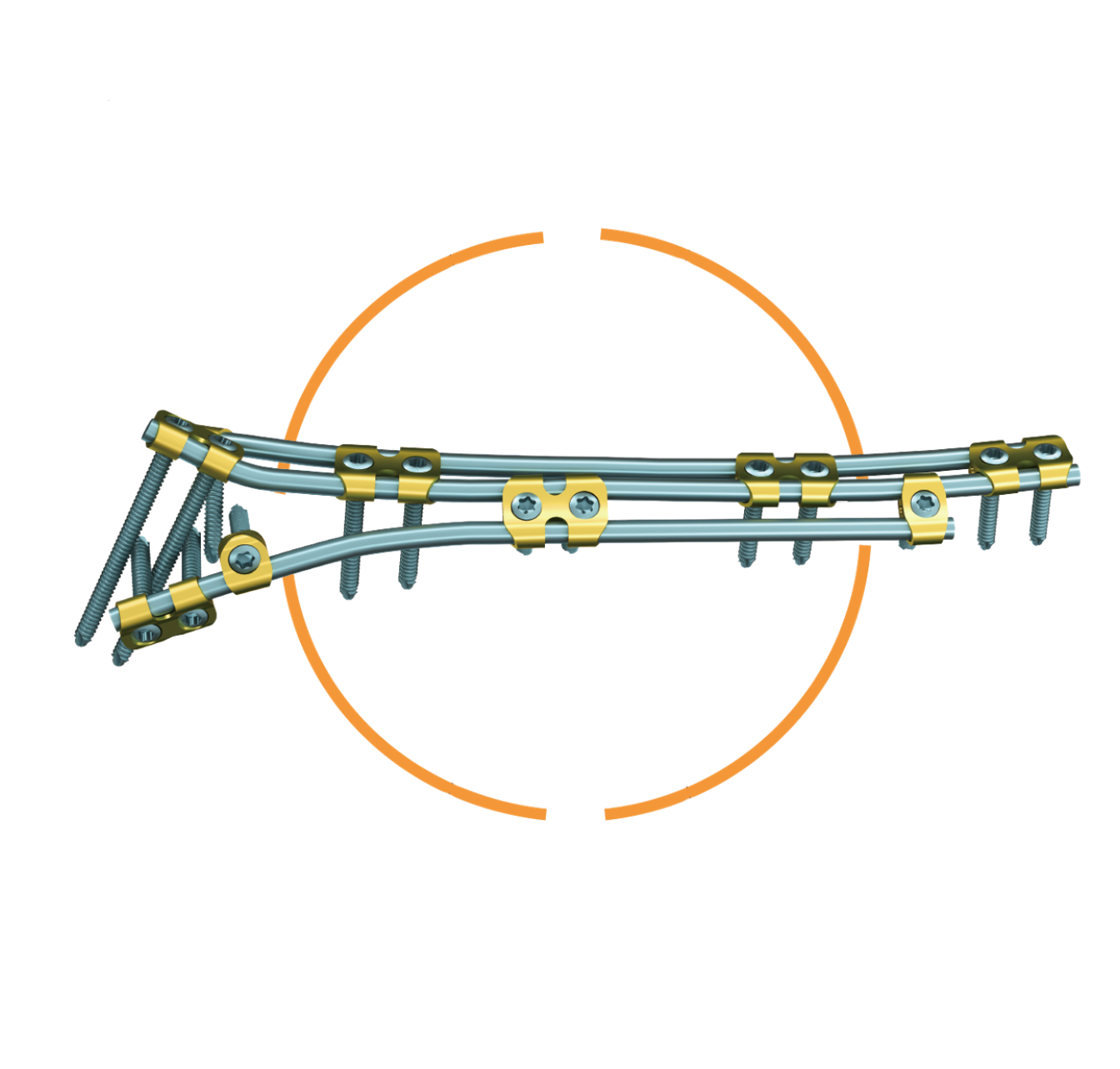 Orthopedic-Bridge System （OBS）-Patented Product