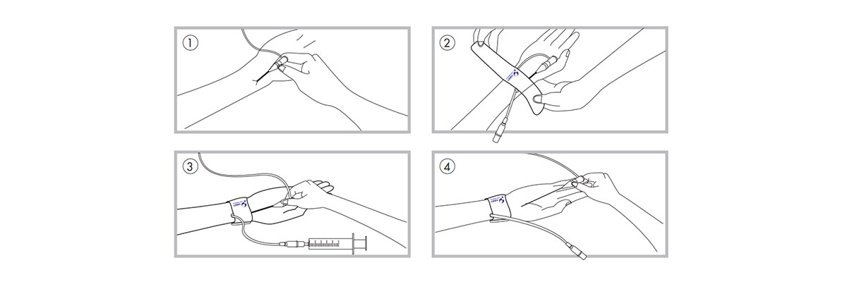 Radial Artery Compression Tourniquet
